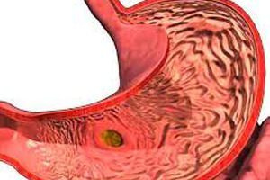 Какая анемия при язвенной болезни желудка thumbnail