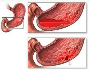 Методы хирургического лечения язвенной болезни желудка thumbnail