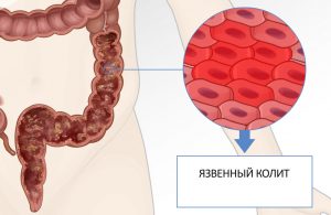 Лечение язвы желудка медом и барсучьим жиром thumbnail
