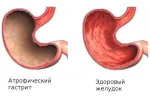 Метаплазия эпителия желудка лечение thumbnail