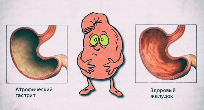Хронический атрофический гастрит hp что это