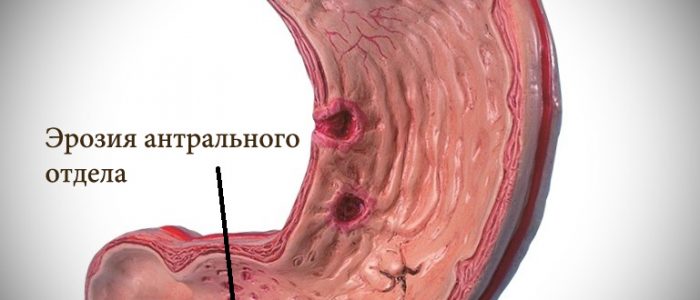 Эрозия желудка антрального отдела желудка лечение thumbnail