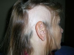 Выпадение волос при проблемах с жкт thumbnail