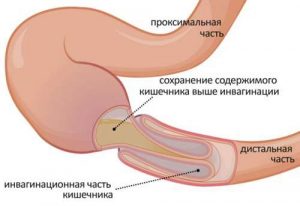 Пневматоз желудка симптомы лечение thumbnail