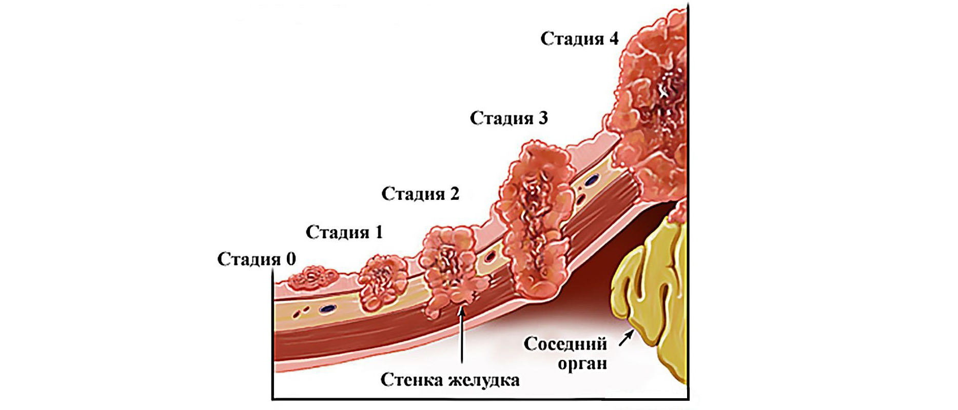 Можно вылечить 4 стадию рака. Стадии развития опухоли желудка. 3 Стадии развития опухоли. Степени онкологии желудка.