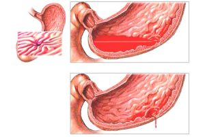 Влияние артериального давления на желудок thumbnail